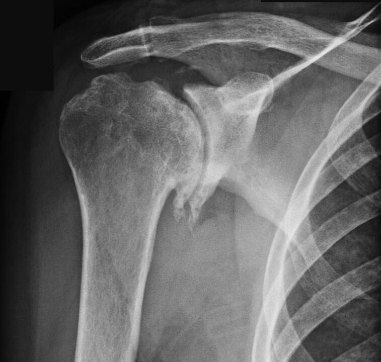 X-ray showed arthrosis of the shoulder