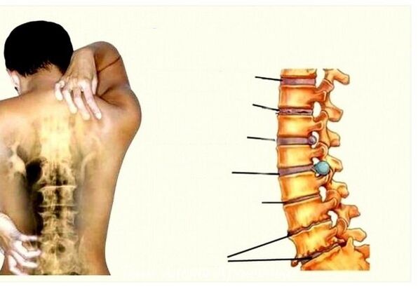 Cervical osteochondrosis stages