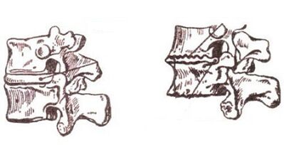 Cervical osteochondrosis development stages