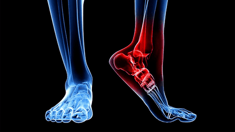 Arthrosis of the ankle articulation