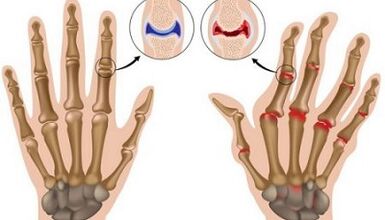 The main differences in arthritis and arthrosis