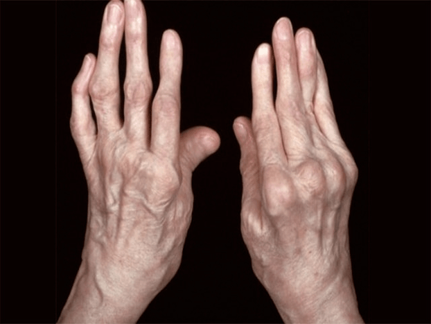Arthritis as a cause of pain in the joints of the fingers
