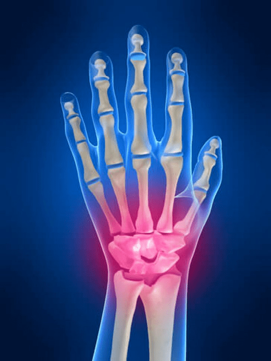 Arthritis of the Articulation of the Fist
