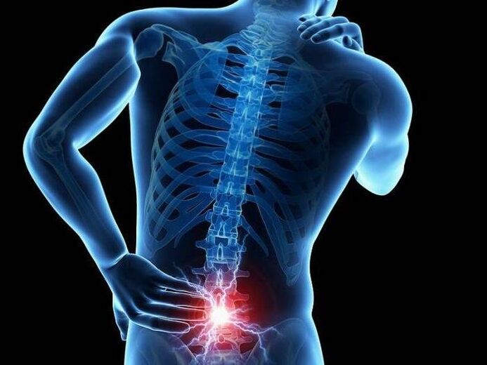 In radiculitis, pinched nerve roots cause sharp pain in the lower back.