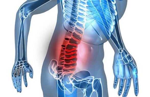 Spinal deformity in the fourth stage of lumbar osteochondrosis