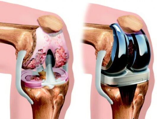 Endoprosthesis replacement is a surgical treatment method in which the affected joint is replaced with a prosthesis.