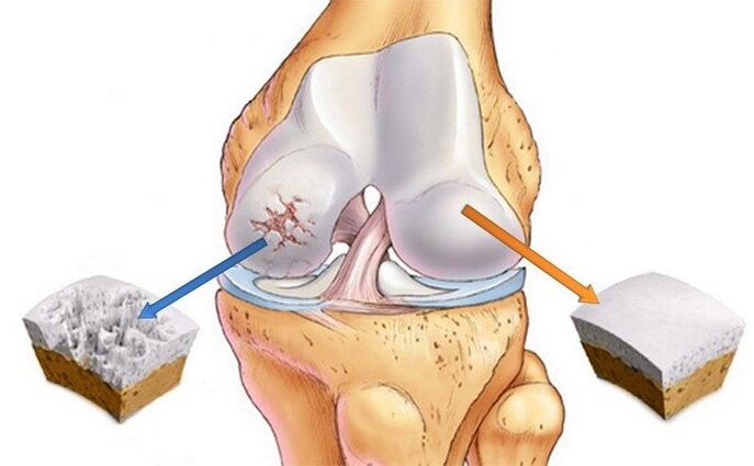 Healthy and arthrotic joints