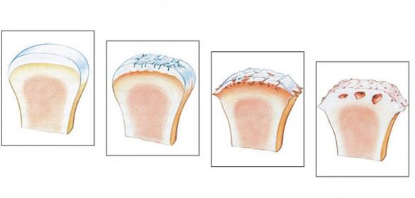 Healthy joint and 3 degrees of osteoarthritis development