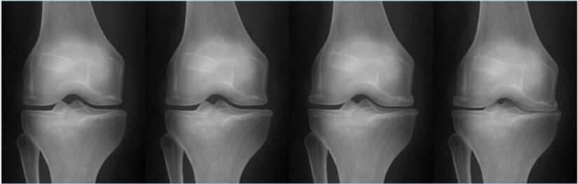 Stages of osteoarthritis according to the Kellgren-Lawrence classification