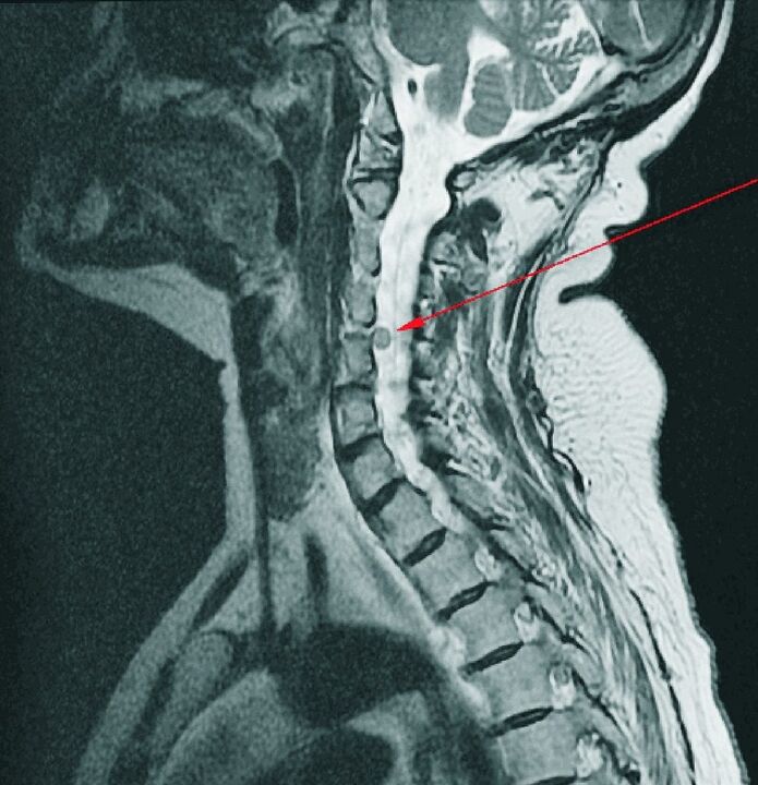 Cervical spine intervertebral hernia on MRI